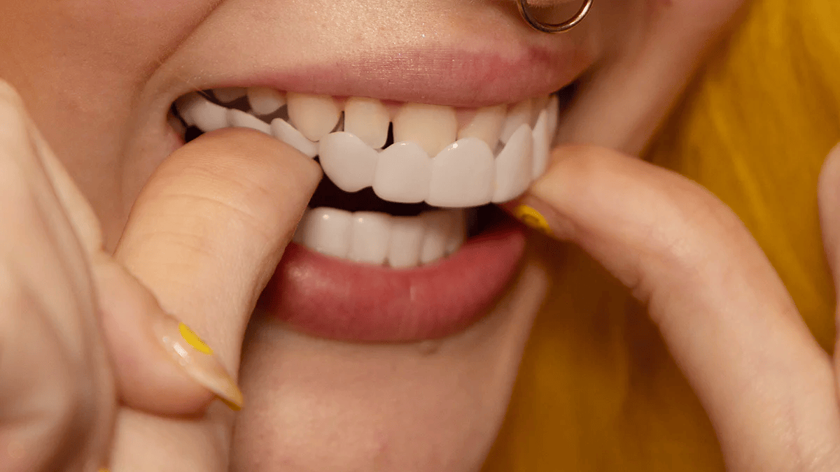 SmileSnap | Instant Veneer Transformation Kit for Aesthetic Tooth Coverage 6